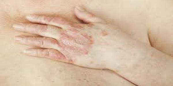 Et le derme au psoriasis comme appliquer